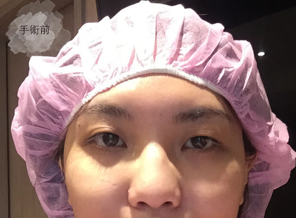 【醫美】我真的去割雙眼皮了！在松江南京站「極緻醫美診所」的手術過程（絕對不是業配文！）